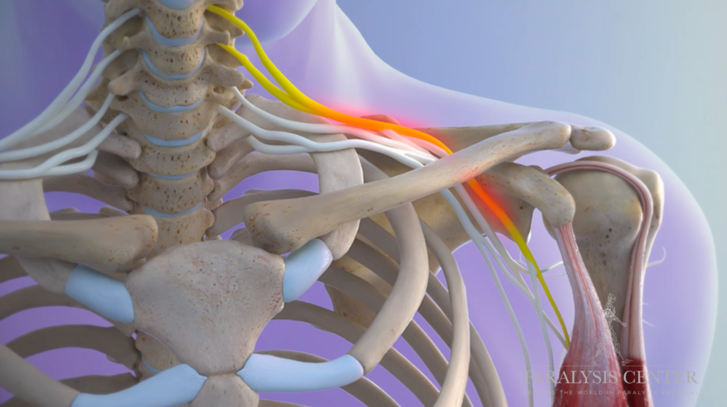 Acute Flaccid Myelitis (AFM): Symptoms and Causes