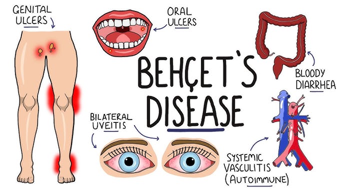Behcet s Disease Symptoms And Causes