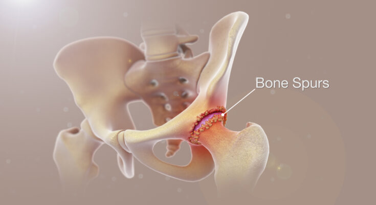 Bone Spurs Diagnosis And Treatment 8765