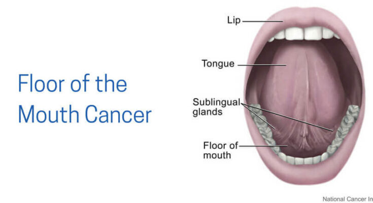 Floor Of The Mouth Cancer Diagnosis And Treatment Floor Of The Mouth Cancer Diagnosis And Treatment